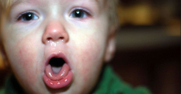 tosse acuta nei bambini